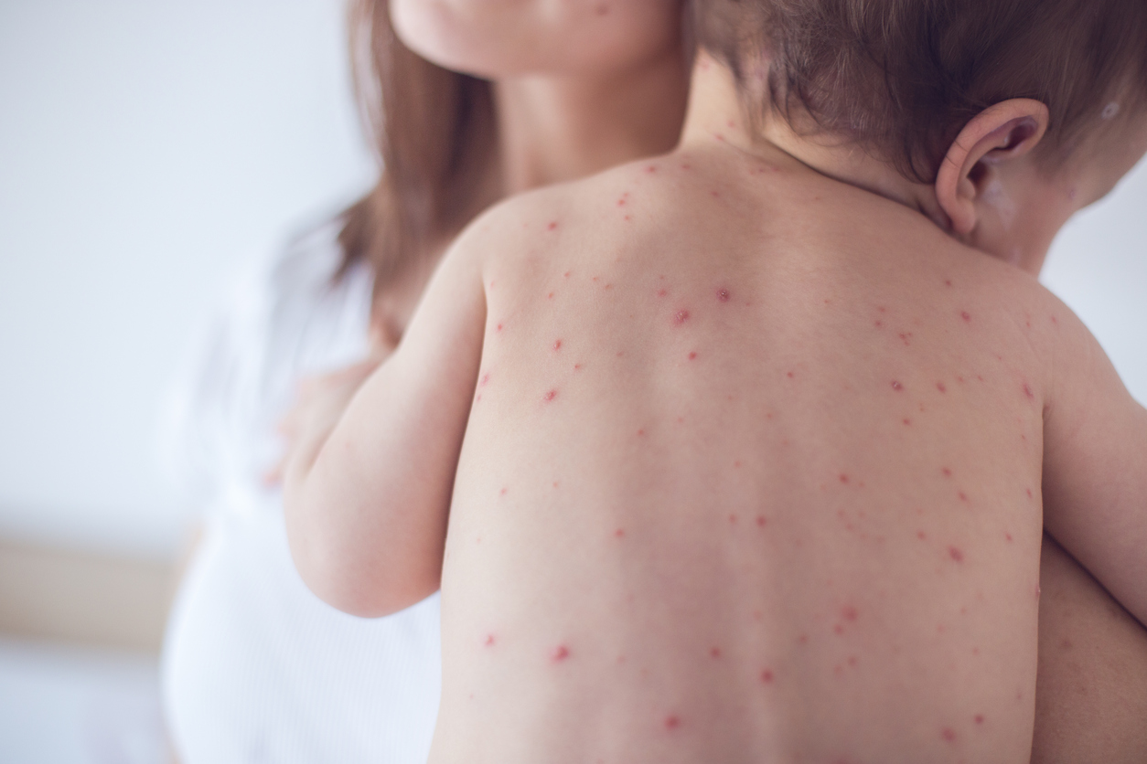 Should The Chickenpox Vaccine Be Offered To All Children Health